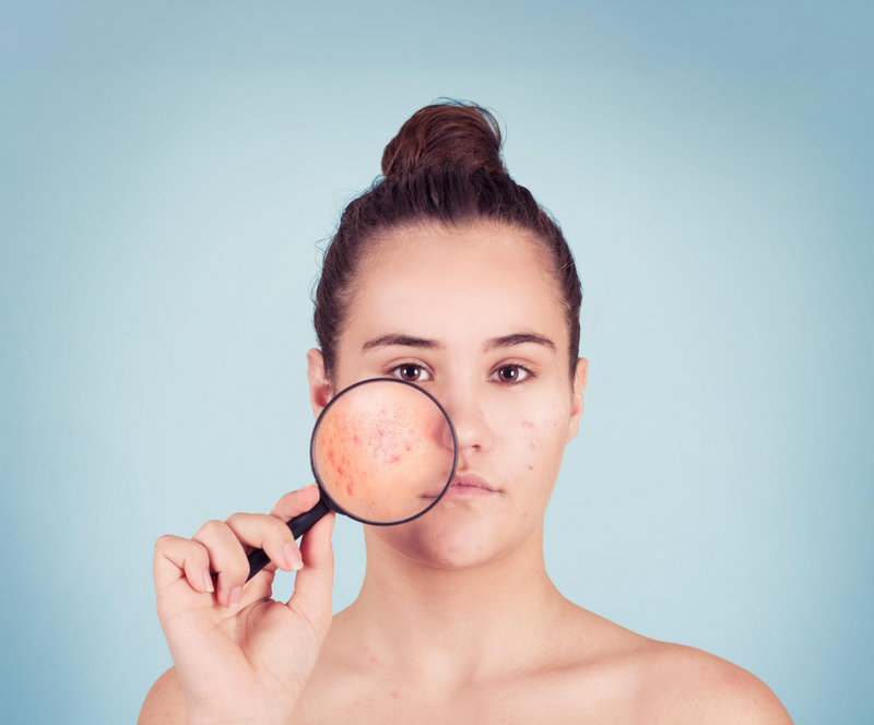 Tip voor tieners met acné. Stappenplan Donkey Milk producten